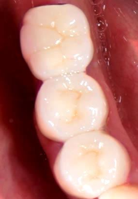 Ceramic molars after
