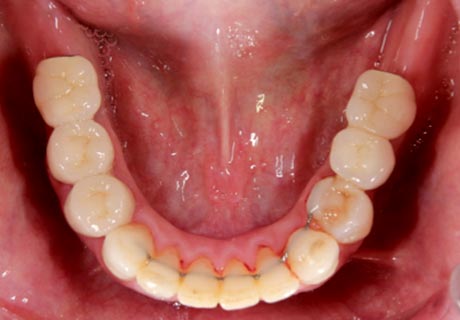 Dental implant rear teeth after